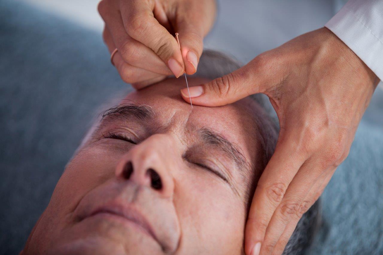 Effects of Acupuncture on Alzheimers