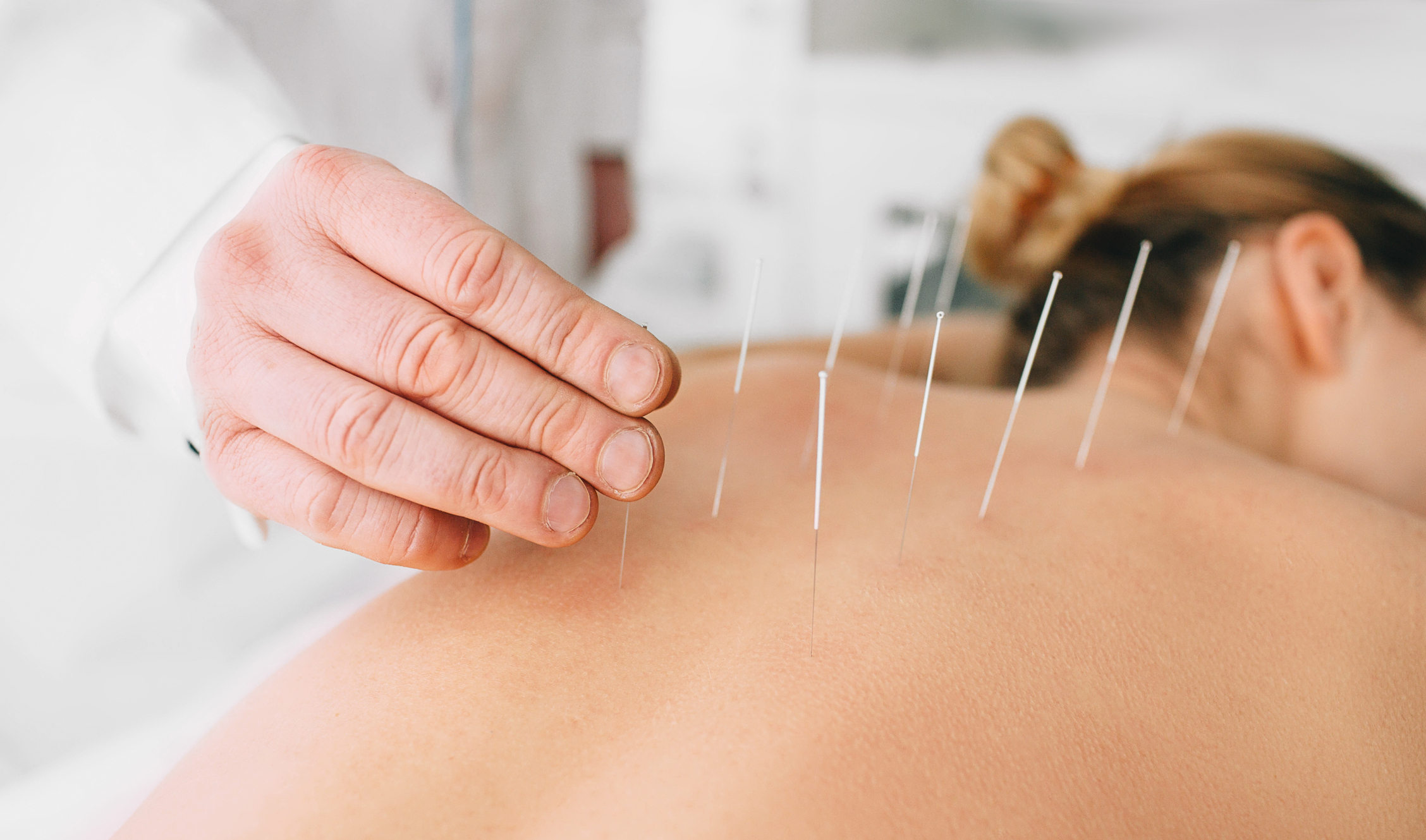 A close-up of an acupuncturist's hand carefully placing thin needles into a woman's bare back during an acupuncture session. The patient lies face down with multiple needles inserted, highlighting the traditional Chinese medicine practice for pain relief and relaxation. Acupuncture for immune health.